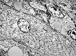 M,31y. | rhabdomyoblasts - tumor? - regeneration? - lip M,31y. | rhabdomyoblasts - tumor? - regeneration? - lip
